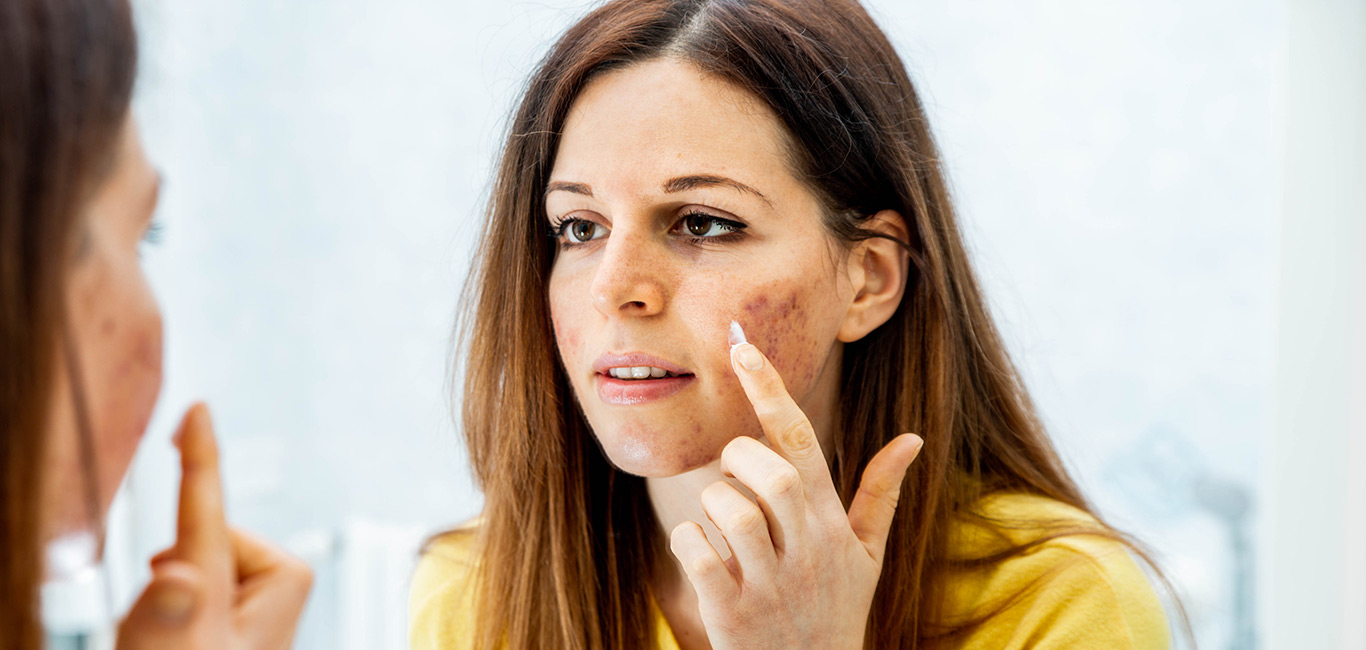 acne informatie