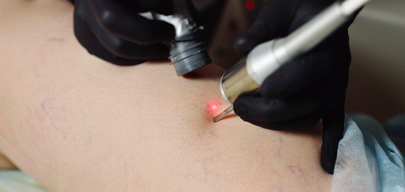 Laser behandeling