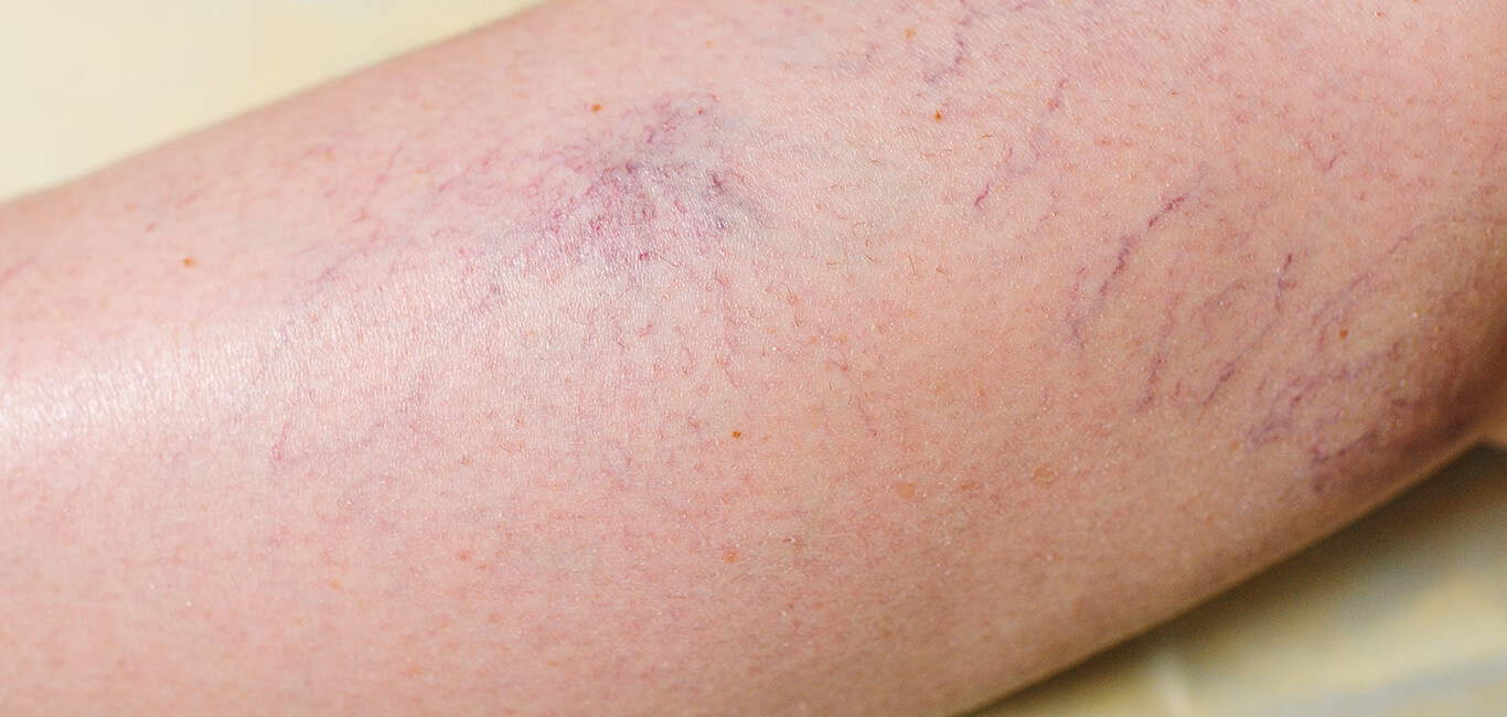 Rosacea huid