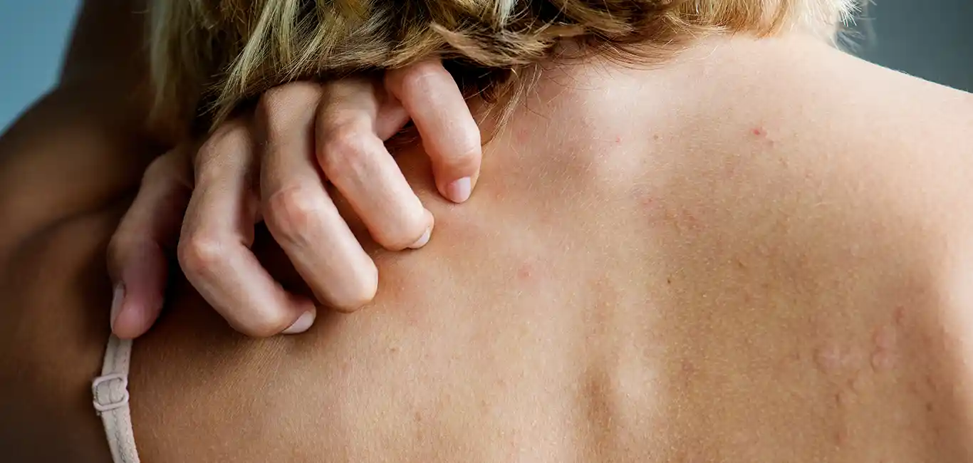 Schrale Huid Jeuk Irritatie droog