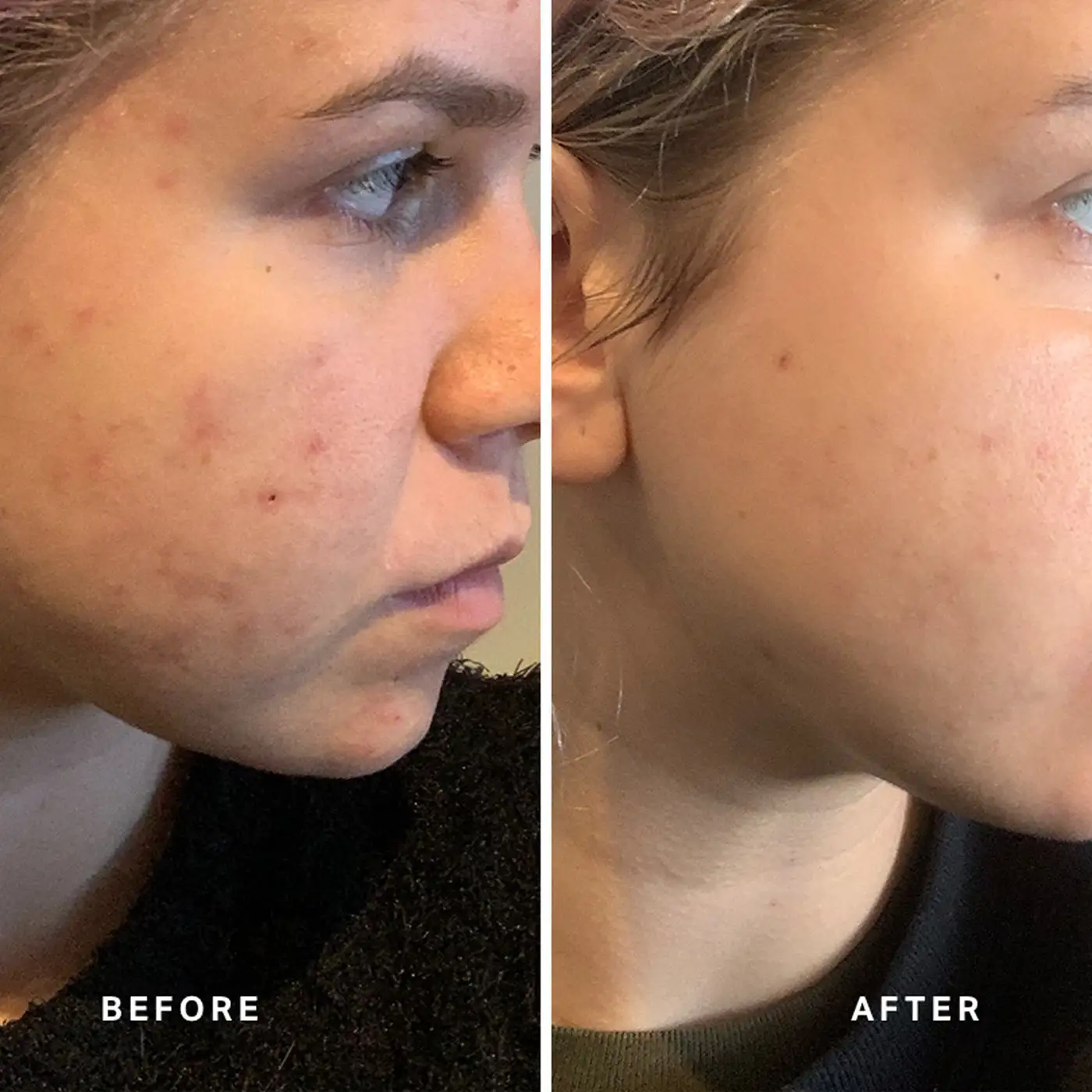 ALPHA-H - Instant Action BHA Blemish Treatment - Before After
