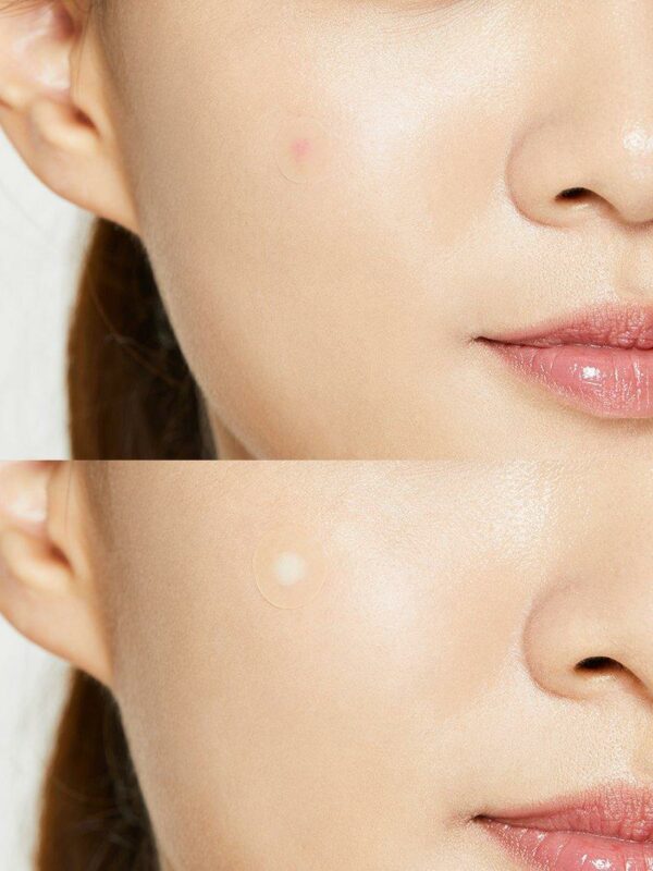 COSRX - Acne Pimple Master - Before After
