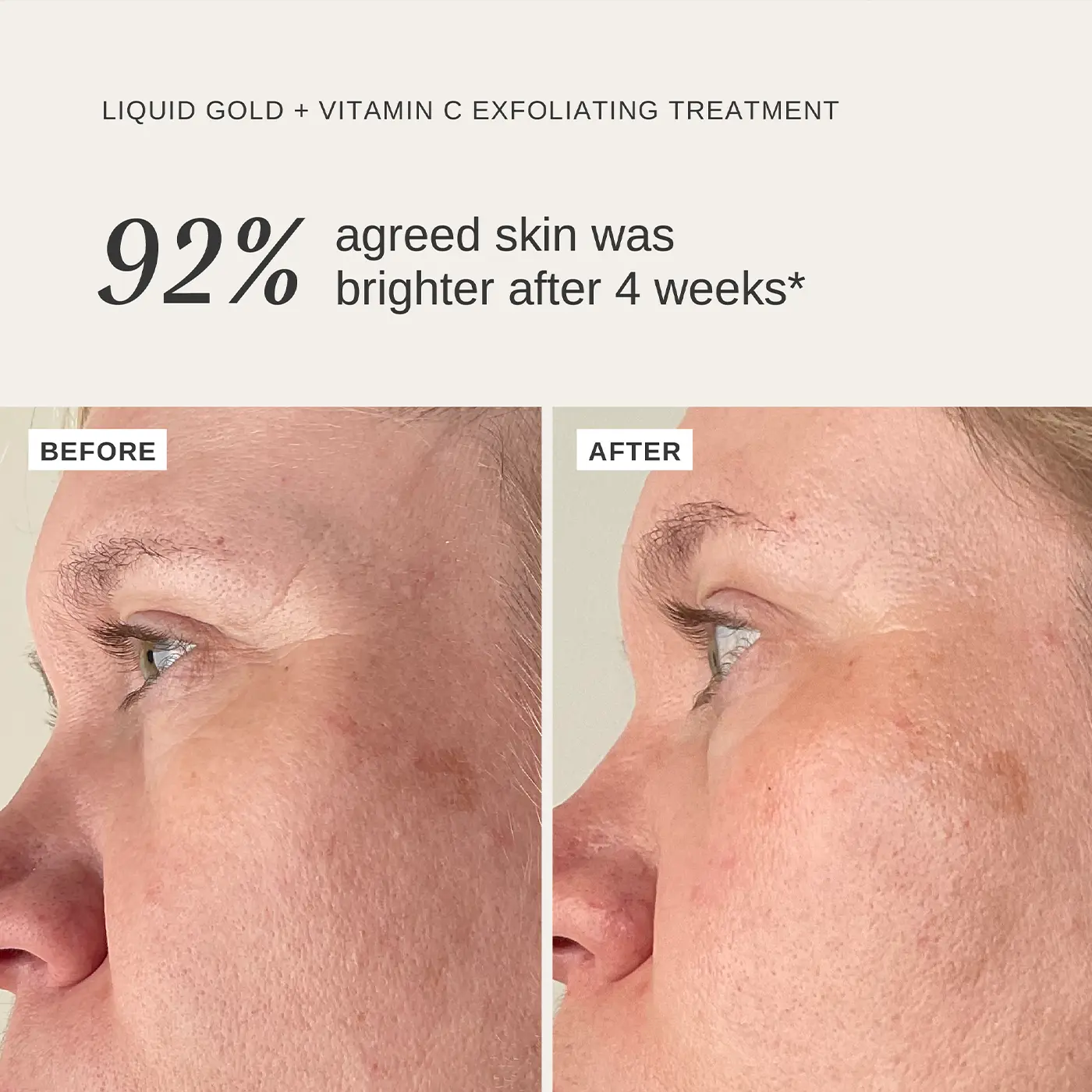 ALPHA - H - Liquid Gold + Vitamin C - Before After